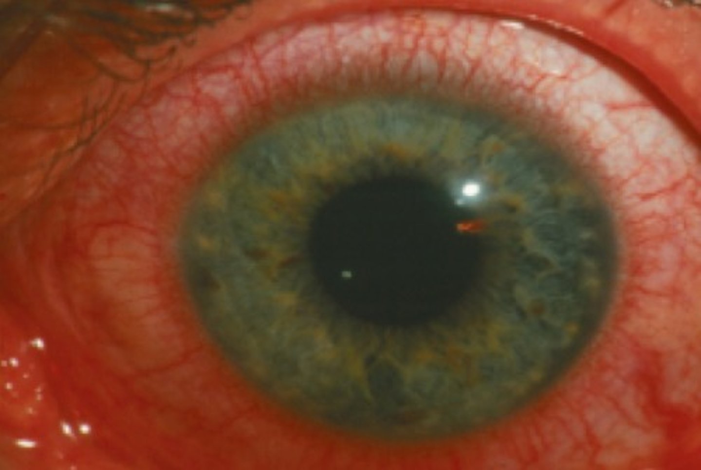 <p>Adult inclusion conjunctivitis is caused by sexually transmitted Chlamydia trachomatis. It's a follicular trachomatis</p><p>In most instances, adult inclusion conjunctivitis results from sexual contact with a person who has a genital infection</p><p>Rarely, adult inclusion conjunctivitis is acquired from contaminated, incompletely chlorinated swimming pool water</p><p>Conjunctival scraping determines whether chlamydia is present in cells taken from the conjunctiva</p>