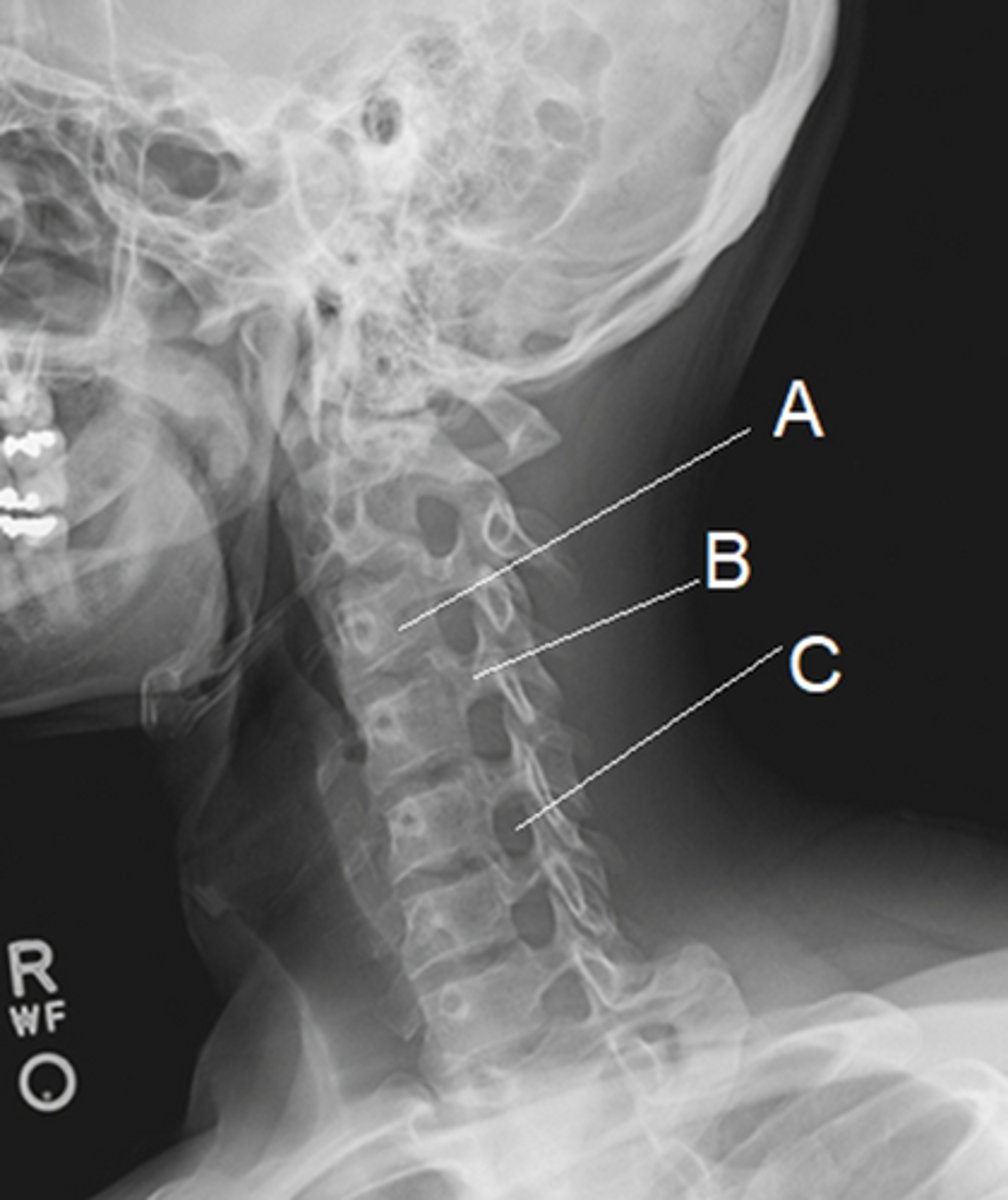<p>Intervertebral foramen (C5-6)</p><p>2 multiple choice options</p>