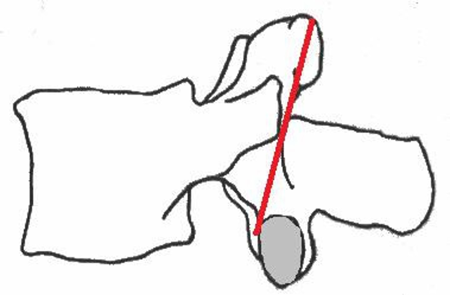 <p>the area between the superior and inferior articulations of the vertebrae; common site of fractures due to spondylolysis</p>