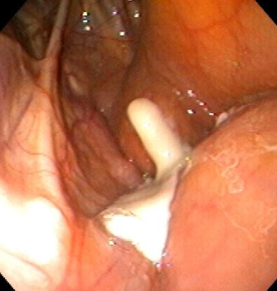 <p>Endoscopic view of a horse’s guttural pouch. Likely cause? </p>