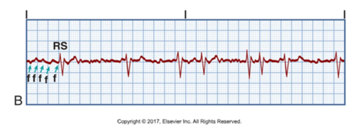 <p>Can be paroxysmal or persistent</p><p>Most common type of dysrhythmia</p><p>Rate: 350-600</p><p>Cause: MI, lung disease, valvular heart disease, hyperthyroidism</p><p>Clinical sig: Decreased cardiac output, blood clots causing stroke or pulmonary embolus</p><p>If duration &lt;48 hours: Digoxin, calcium channel blockers, beta-blockers, amiodarone, cardioversion</p><p>If duration &gt;48 hours: Anticoagulation , TEE, cardioversion</p>