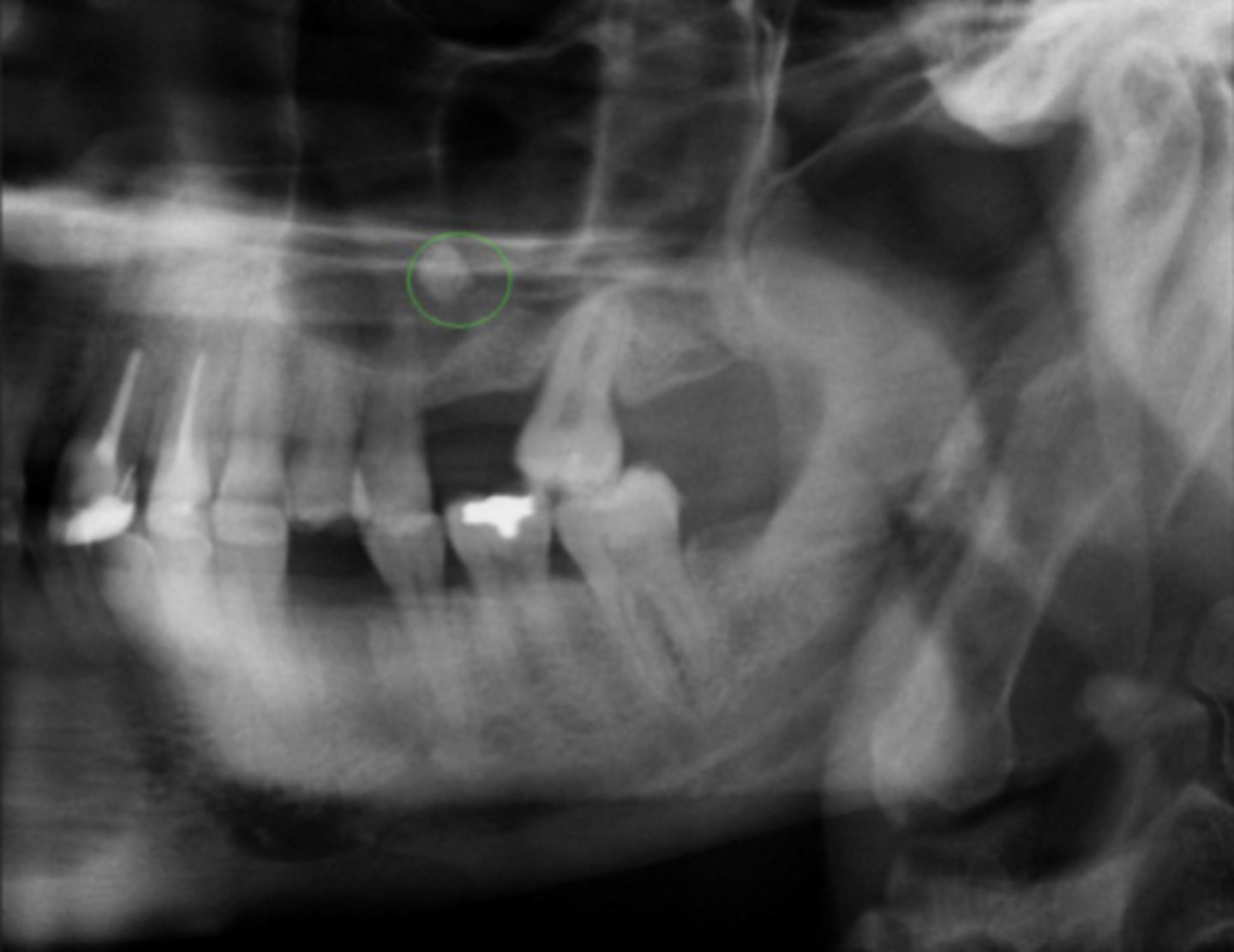 <p>Sinus Stones: calcified masses within paranasal sinuses</p>