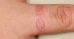 <p><strong>Inflammatory</strong></p><p><strong>Causes:</strong></p><ul><li><p>Antigenic substance exposure.</p></li><li><p>Allergy to nickel or cobalt in clothing, hardware, or dyes.</p></li><li><p><strong>Exposure to highly allergenic plants</strong>:</p><ul><li><p>Poison ivy, oak, and sumac.</p></li></ul></li></ul><p><strong>Complications:</strong></p><ul><li><p>Secondary bacterial infections.</p></li><li><p>Lichenification or hyperpigmentation, particularly in dark-skinned people.</p></li></ul><p><strong>Medications:</strong></p><ul><li><p>Antihistamines, corticosteroids, antibiotics.</p></li></ul><p></p>