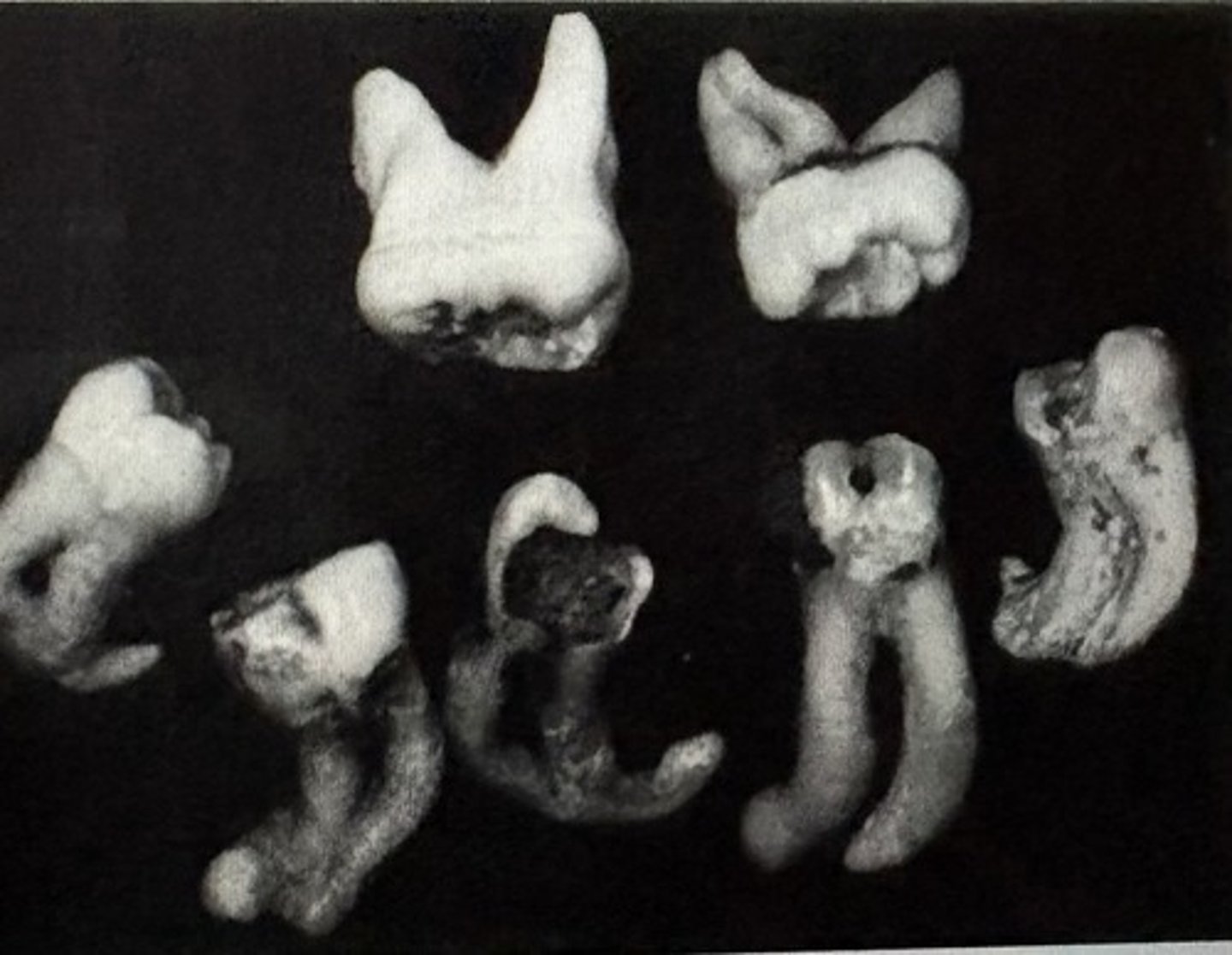 <p>severe bending of the roots</p><p>c <span><span>an make endodontic</span></span><br><span><span>treatment very challenging</span></span><br><span><span>○ Can make extractions more</span></span><br><span><span>complicated</span></span></p>