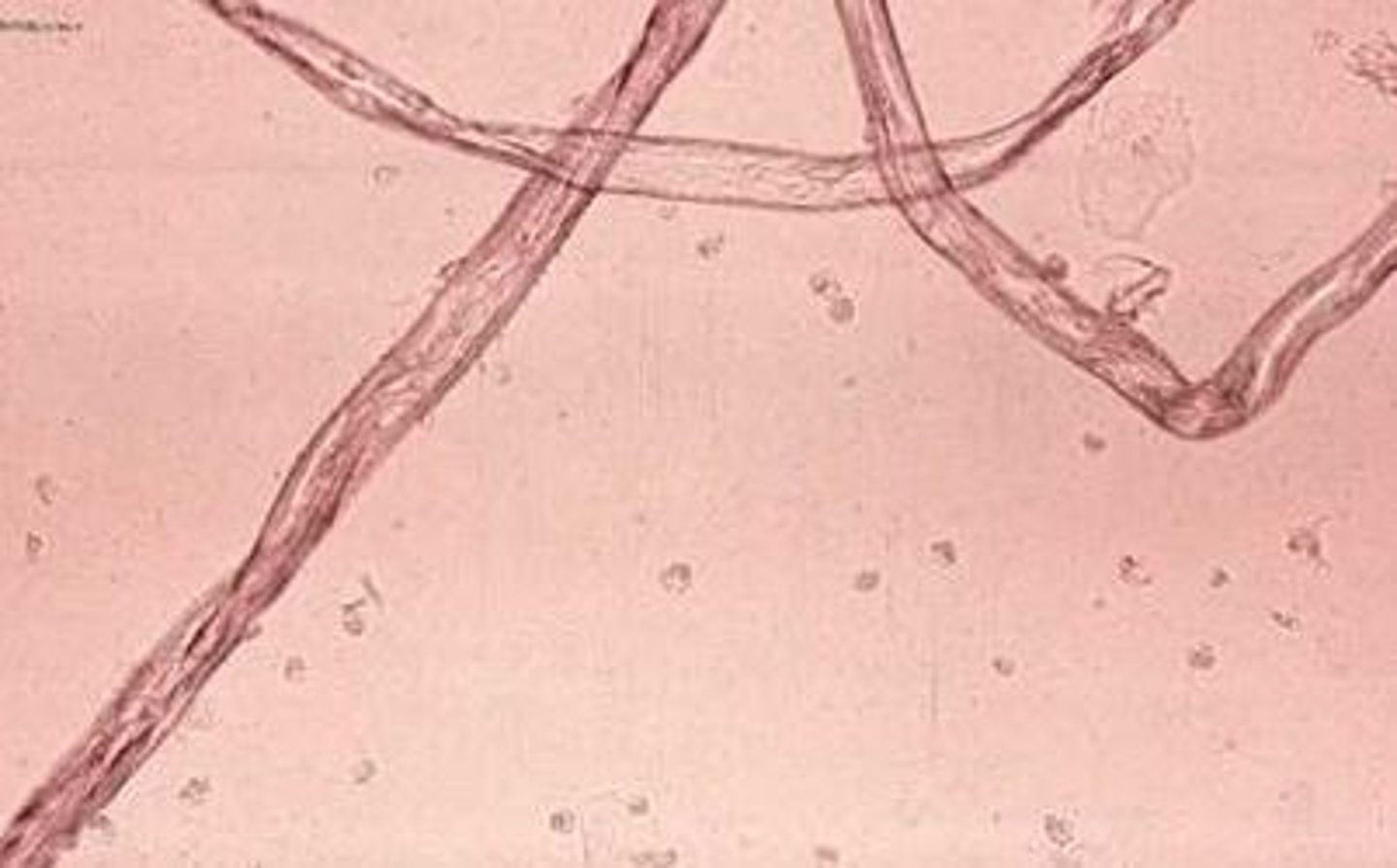 <p>Much longer and more refractile than casts, from hairs or diaper fibers. They also usually polarize and can be distinguished under the microscope.</p>