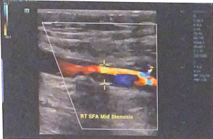 <p>Are the calipers placed in this image to measure the true or residual lumen?</p>