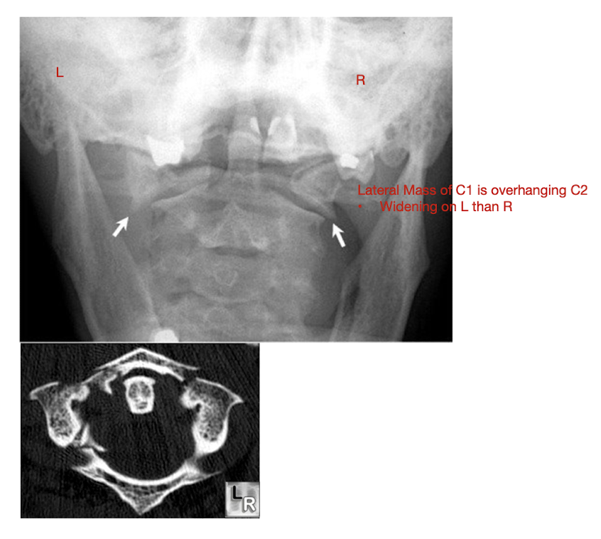 <ul><li><p>Neurological Injury </p><ul><li><p>Fwd flex w Jefferson Fx</p></li></ul></li><li><p>Open mouth view</p></li><li><p>Lateral Mass Displacement </p></li></ul><p></p>