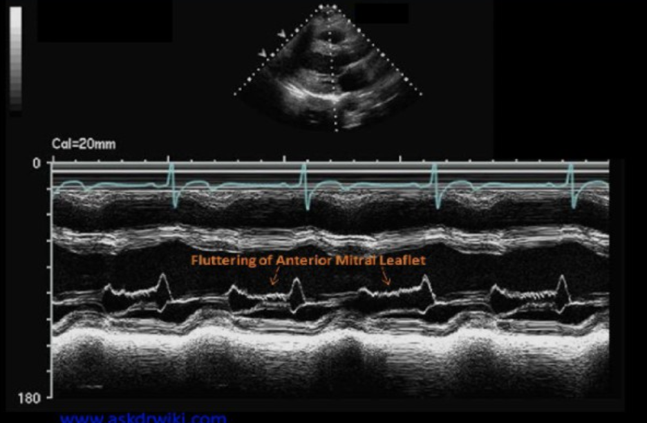 <p>AI can be detected on m-mode by?</p>