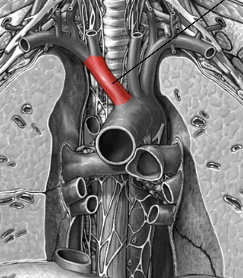 <p>Which arteries:</p><ul><li><p>Extends from aorta arch</p></li><li><p>Inferior to right common carotid &amp; right subclavian</p></li></ul><p></p>