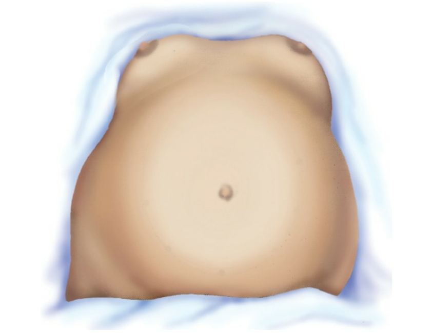 <p>The nurse performed Leopold’s maneuvers and determined that the fetal position is right occiput anterior (ROA). Identify the area where the nurse would place the Doppler to <strong>most </strong>easily hear fetal heart sounds.</p>