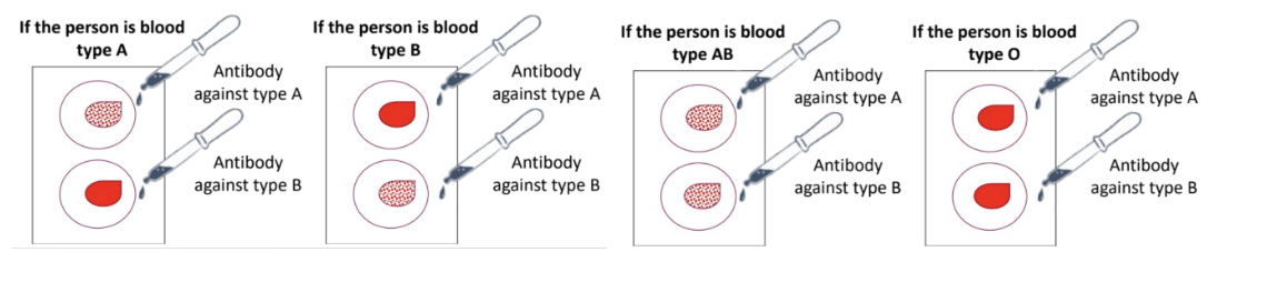 <ol><li><p><span style="background-color: transparent;"><span>Take a glass slide with wells&nbsp;</span></span></p></li><li><p><span style="background-color: transparent;"><span>Prick finger and add blood sample to the wells</span></span></p></li><li><p><span style="background-color: transparent;"><span>Add antibodies against different antigens into the wells ⇒ see if clotting occurs&nbsp;</span></span></p></li></ol><ul><li><p><span style="background-color: transparent;"><span>If clotting occurs, WILL BE that blood type ʙ that “antibody against type A” will look for type A antigens ⇒ if found == clotting = blood is type A&nbsp;</span></span></p></li></ul><p><br></p>
