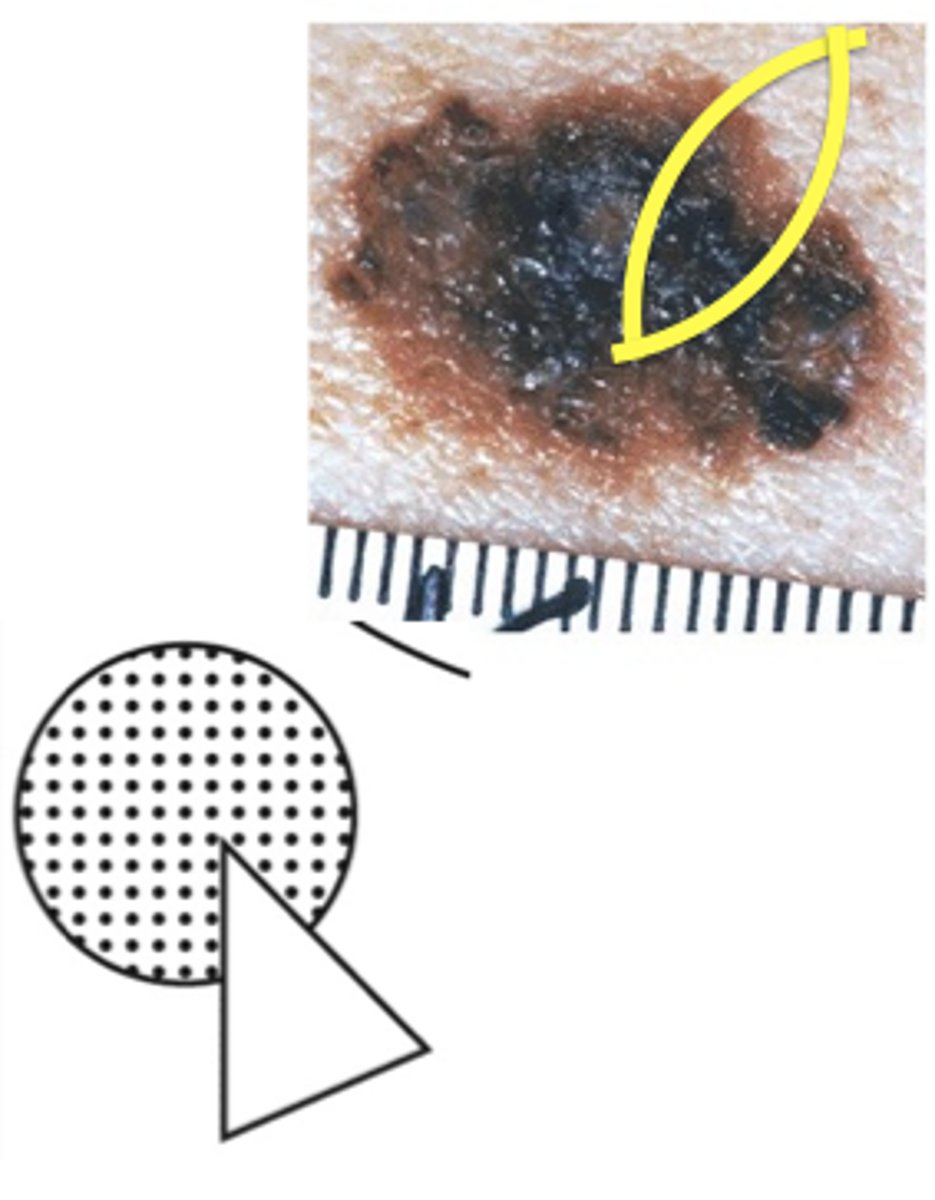 <p>incisional biopsy (taking a piece of the pie)</p>