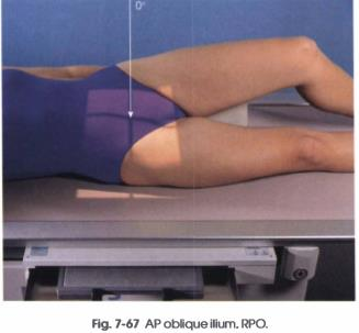 <p><span><strong>PP: </strong>Supine; RPO/LPO; unaffected side elevated 40o (places broad surface of the wing of affected ilium // to IR); shoulder, hip &amp; knee elevated</span></p><p><span><strong>RP: </strong>Level of ASIS</span></p><p><span><strong>CR: </strong>┴</span></p><p><span><strong>SS:</strong></span><br><span>• Unobstructed projection of ala &amp; sciatic notches</span><br><span>• Profile image of acetabulum</span><br><span>• Broad surface of the iliac wing without rotation</span></p>