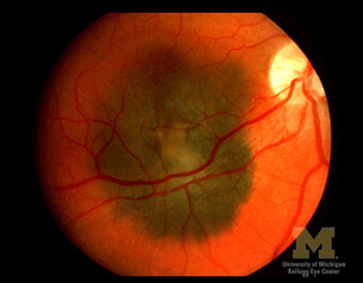 <p>malignant tumor of melanocytes in choroid (middle aged blue eyes) --&gt; asymptomatic<br>-Frequently have lipofuscin on surface<br>Shape: subretinal, dome shaped, elevated mass<br>Exudative RD common<br>B-scan: mushroom/button-shirt appearance when melanoma breaks through bruch's membrane</p>