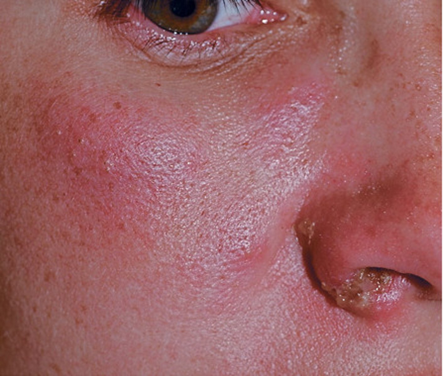 <p>Impetigo</p><p>Mupirocin</p>