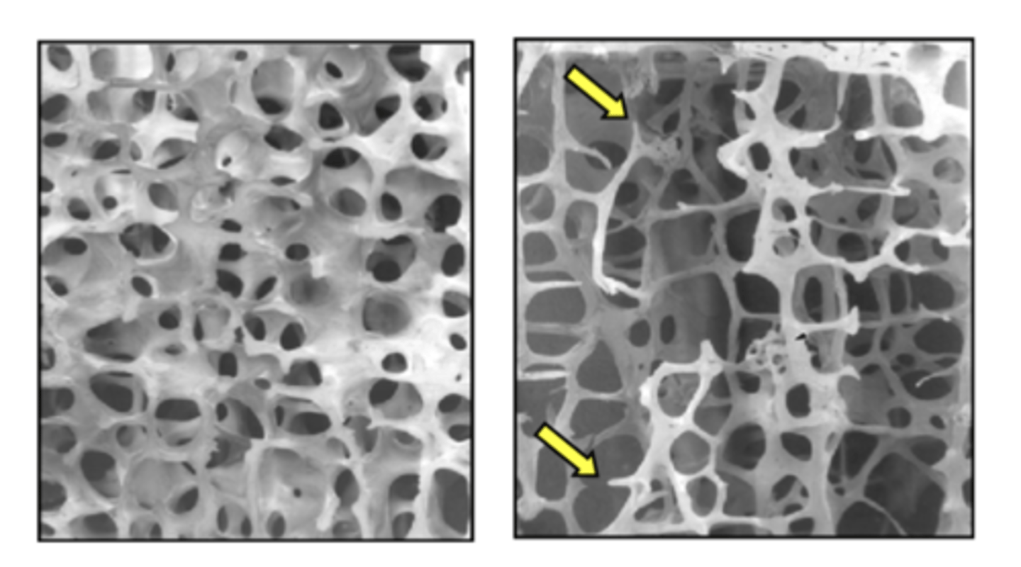 <p>a condition where decreased bone density can lead to fractures.</p>