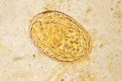<p>in human stool</p><p>cercarial dermatitis, eosinophilia</p><p>history of long term water exposure</p><p>East Asia, Pacific Asia</p>