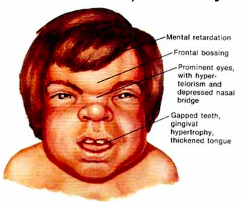 <p>Mucopolysacchride disorder</p><ul><li><p>gargoylism</p></li><li><p>usually fatal in childhood</p></li></ul><p></p>