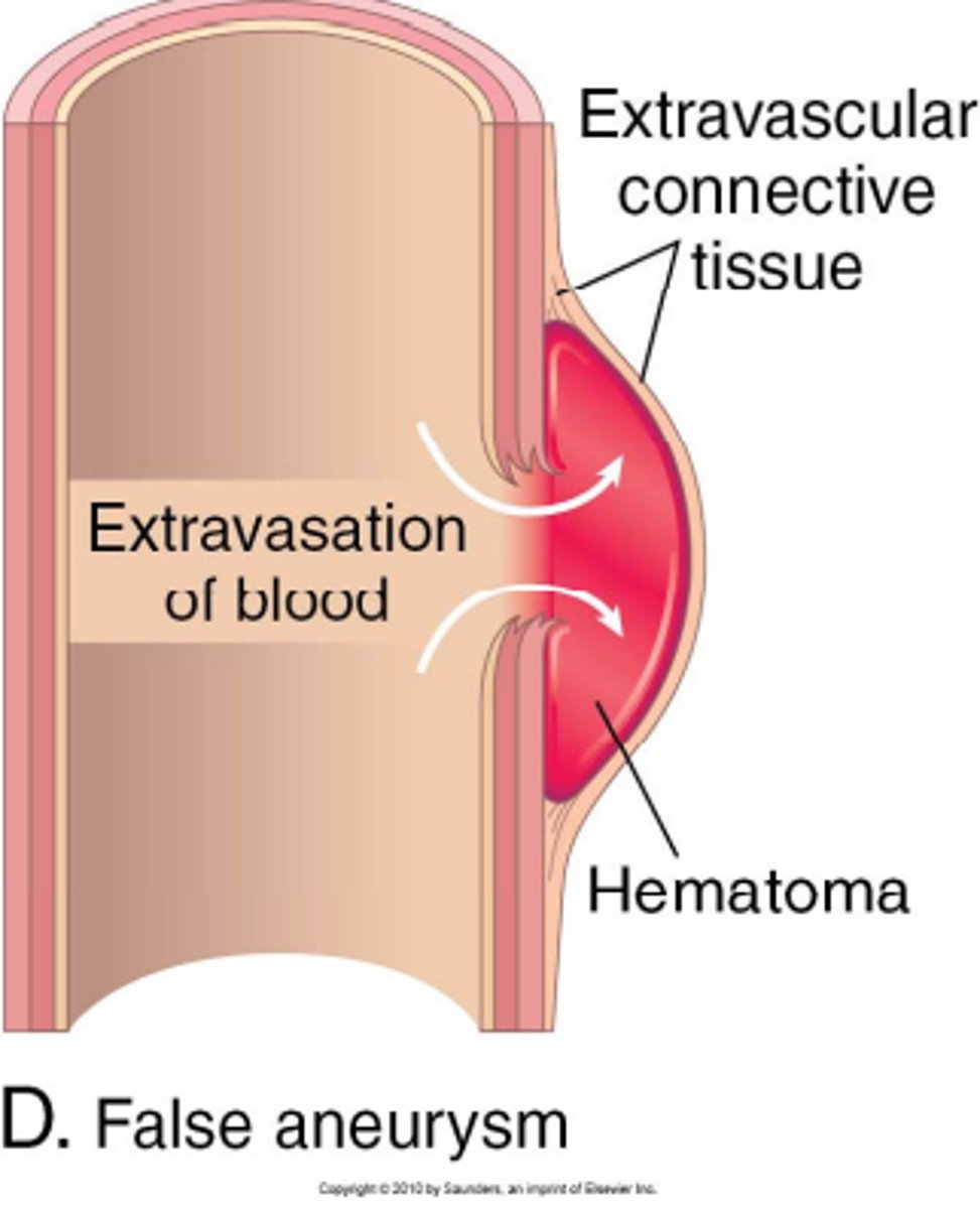 <p>break through all layers and surrounding tissue forms a false wall with a clot</p>
