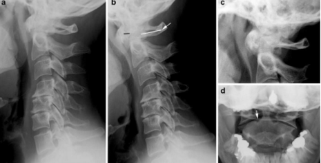 <p>affects the carpals 7 proximal joints of the hand</p><ul><li><p>can <span style="color: blue;"><strong><mark data-color="blue" style="background-color: blue; color: inherit;">widen the predentate space</mark></strong></span> in the<strong> </strong><span style="color: blue;"><strong><mark data-color="blue" style="background-color: blue; color: inherit;">cervical spine</mark></strong></span>&nbsp;</p></li><li><p>can lead to <strong>fusion of the posterior elements</strong> in the cervical spine</p></li></ul><p></p>