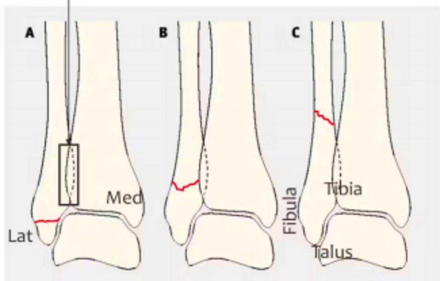<p>Type A = below syndesmosis</p><p>Type B = at the level of the syndesmosis</p><p>Type C = above the syndesmosis</p><p>*The syndesmosis is a fibrous joint held together by ligaments near the ankle joint </p>