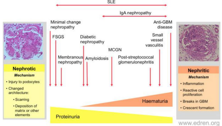 <p>Two Main Clinical Patterns - ______________:</p><ul><li><p>Characterized by <span style="color: blue;"><strong>proteinuria</strong></span></p><ul><li><p>Minimal change disease</p></li><li><p>Membranous nephropathy</p></li><li><p>Focal segmental glomerulosclerosis</p></li></ul></li></ul><p></p>