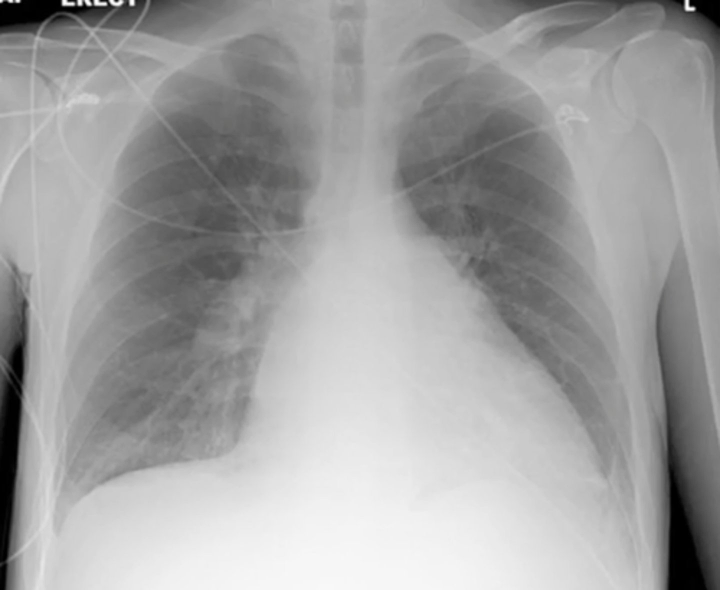 <p>(evaluating AP CXR) cardiomegaly where only left ventricle is enlarged; usually caused by HTN</p>