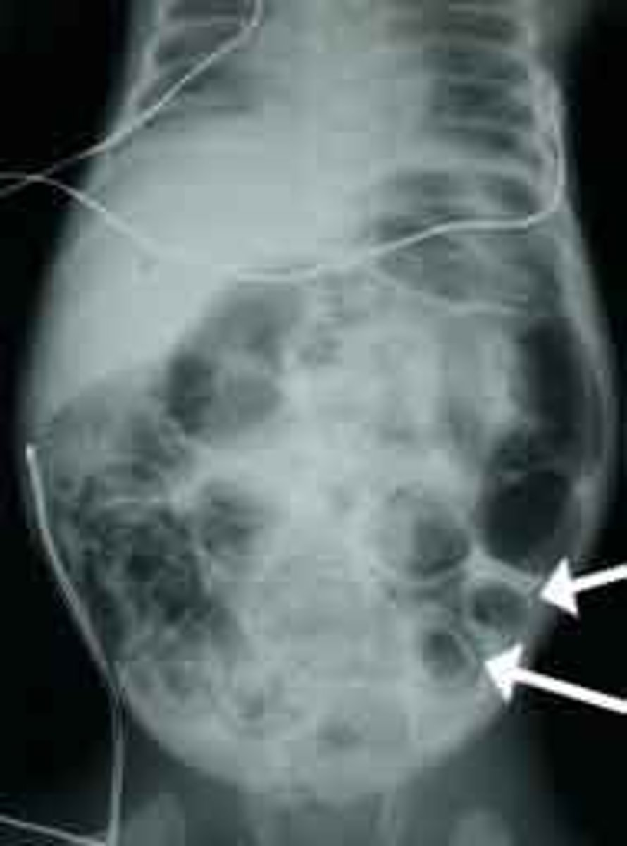 <p>Abdominal x-ray; pneumatosis intestinalis (intramural air, dilated bowel, &amp; edematous walls)</p>
