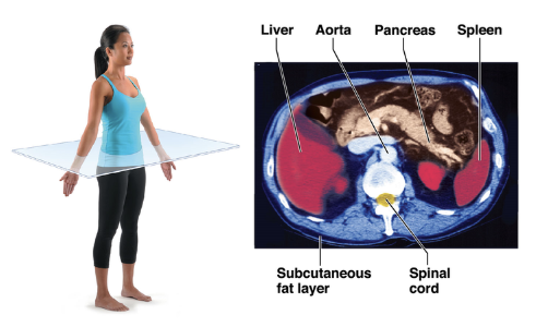 <p>A ____ MRI through the abdomen shows the liver, spinal, aorta, pancreas, and spleen</p>