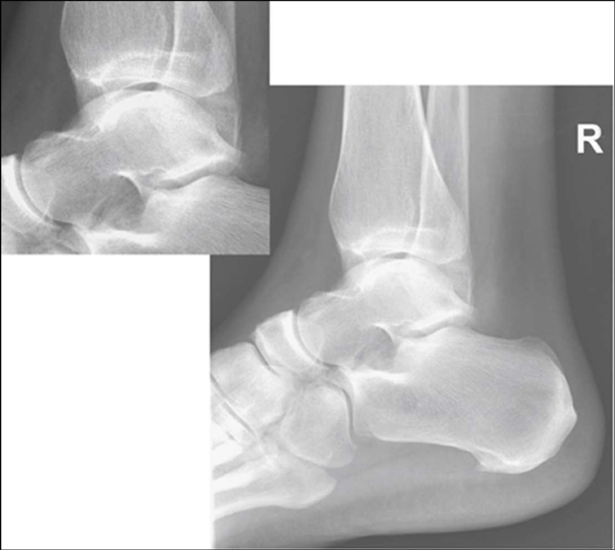 <p>is this lateral ankle over or under rotated</p>
