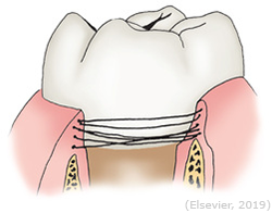 <ul><li><p>Support the gingiva that surrounds the tooth.</p></li><li><p>Contain the following fiber sub-groupings:</p><ul><li><p><strong>Gingival fibers</strong></p></li><li><p><strong>Circular fibers</strong></p></li></ul></li></ul><p></p>