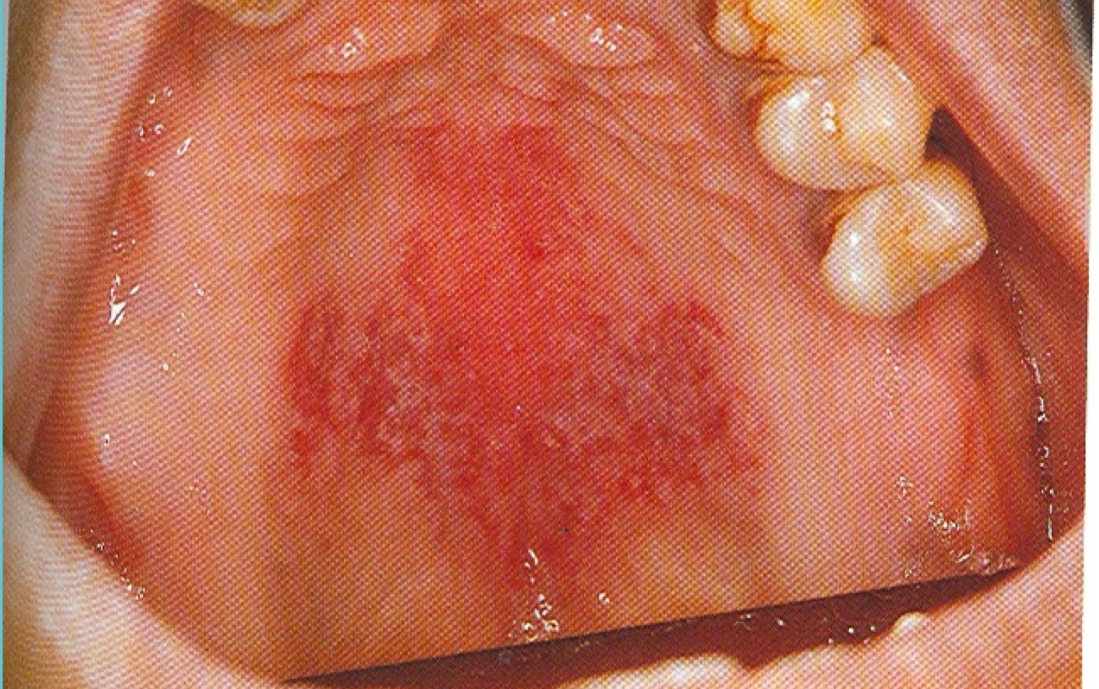 <p>Erythroplakia </p>