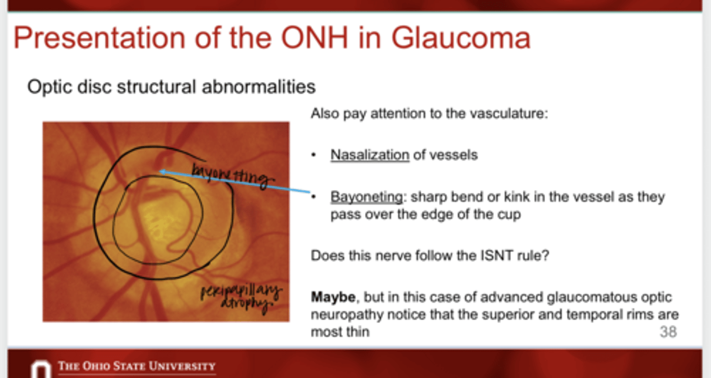 <p>What is bayonetting of vessels in glaucoma?</p>
