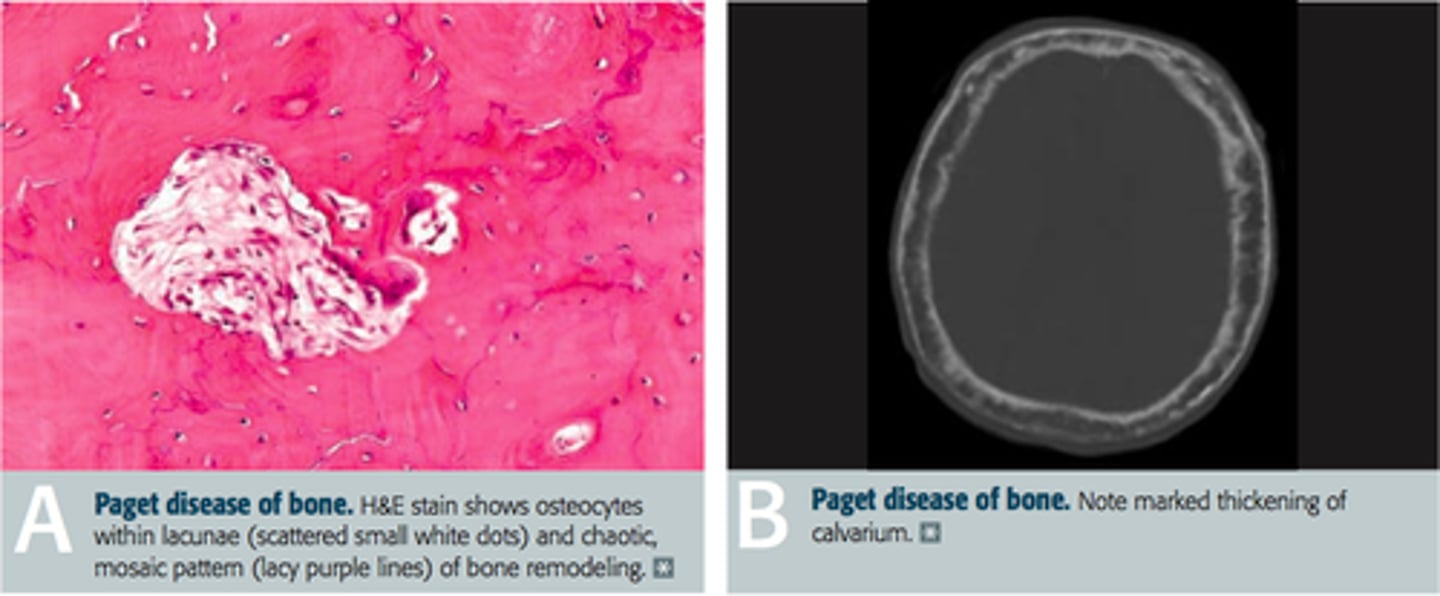 <p>Paget disease of bone (Increased osteoclastic, then osteoblastic activity)</p><p>Osteosarcoma or heart failure</p>