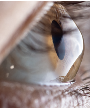 <p>One of the 6 Corneal Abnormalities</p><ul><li><p>A progressive, degenerative disorder where the cornea thins and bulges into a cone shape, leading to distorted vision</p></li></ul><p></p>