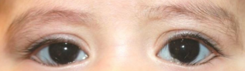 <p>What eyelash condition is this?</p>