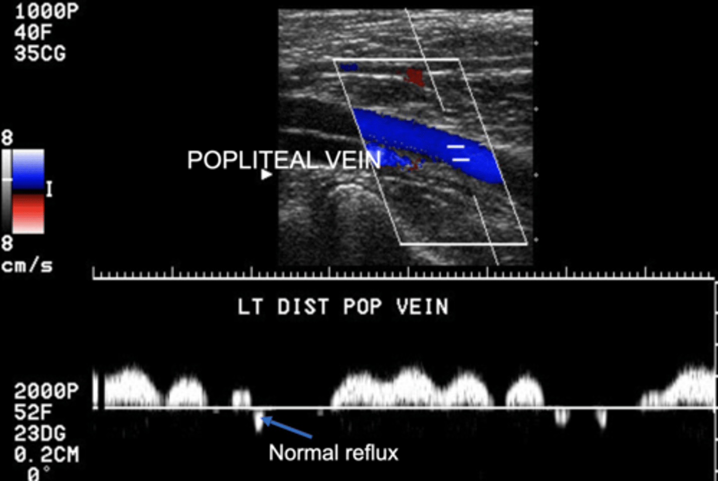 <p>Small amount of flow in the opposite channel is normal</p>