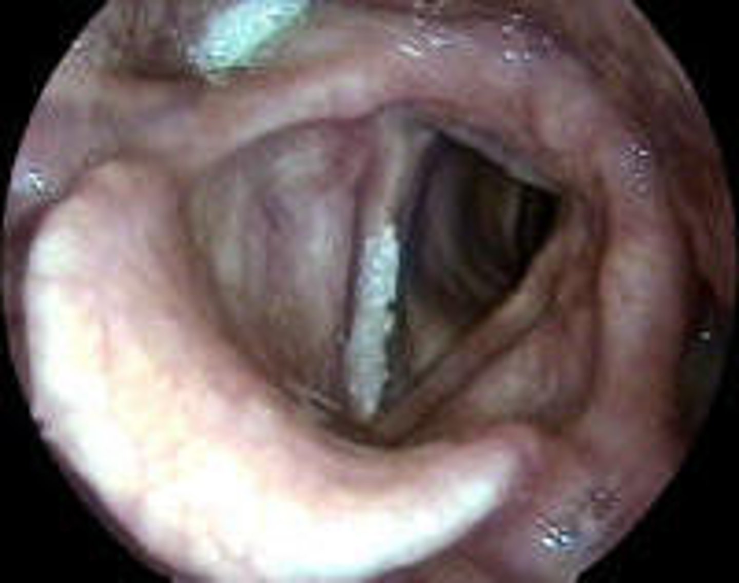 <p>- Hoarseness</p><p>- Odynophagia, Dysphagia</p><p>- ↓ tongue mobility</p><p>- Otalgia—ear pain</p><p>- Airway obstruction</p><p>- Cranial neuropathies</p><p>- Trismus</p><p>- Fistulas</p>