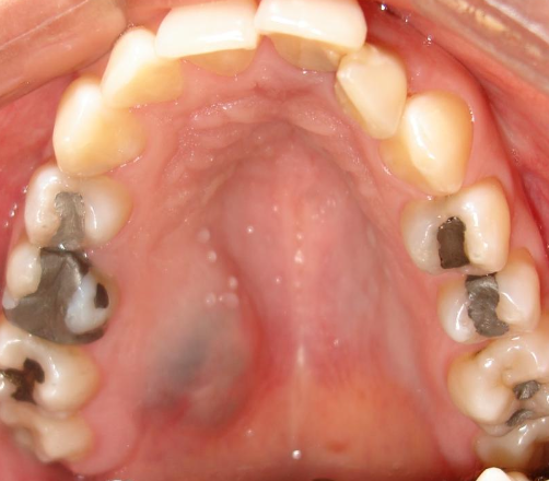 <p>What is another name for a salivary gland neoplasm?</p>