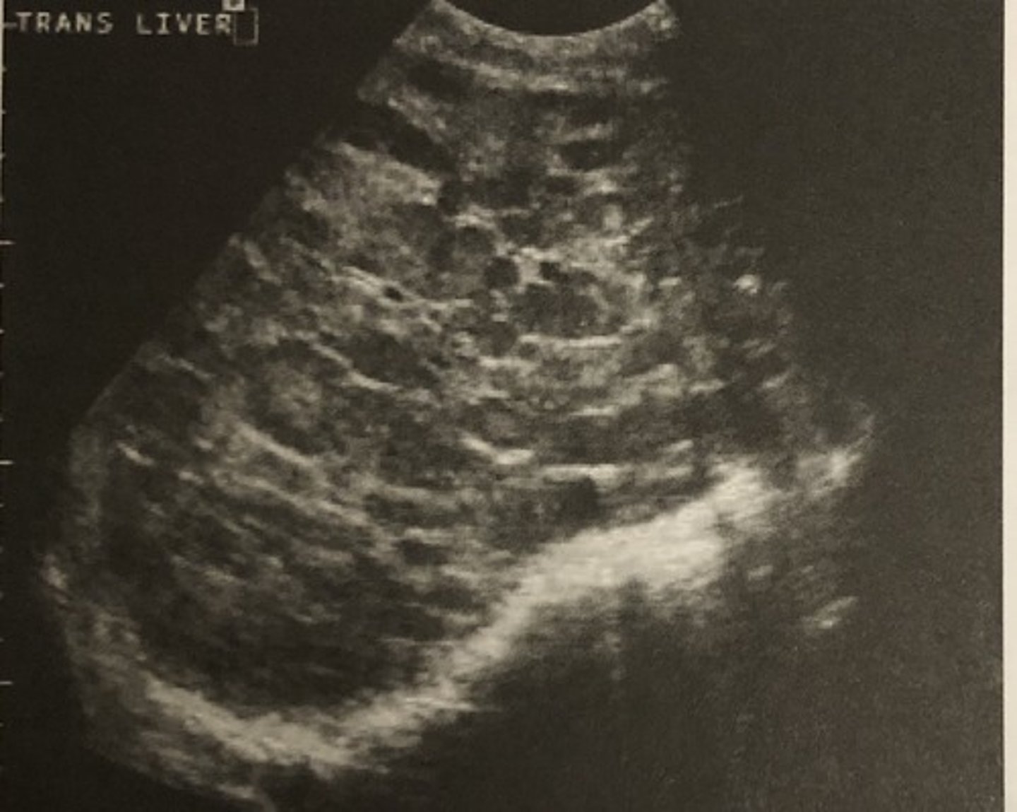 <p>638. In the patient described in question 636, evaluation of her right upper quadrant indicates:</p><p>A. Metastatic liver disease</p><p>B. Liver abscess</p><p>C. Normal liver</p><p>D. Abdominal ascites</p><p>E. Perihepatitis</p>