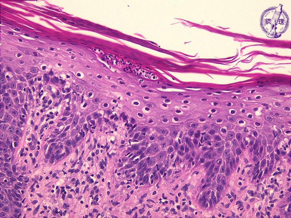 <p>within the parakeratotic area of the stratum corneum layer </p>