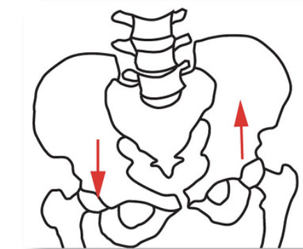 Frontal plane: right pelvis moves inferiorly relative to left pelvis 