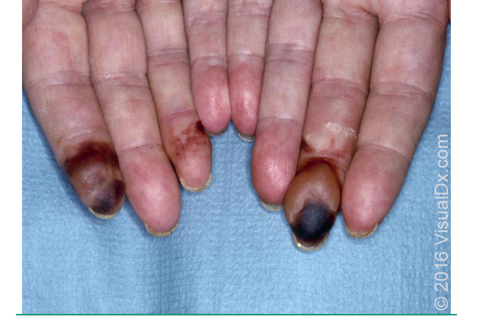 <p>systemic necrotizing vasculitis that typically affects medium sized muscular arteries, w/ additional involvement of small arteries</p><p>cause- idiopathic</p>