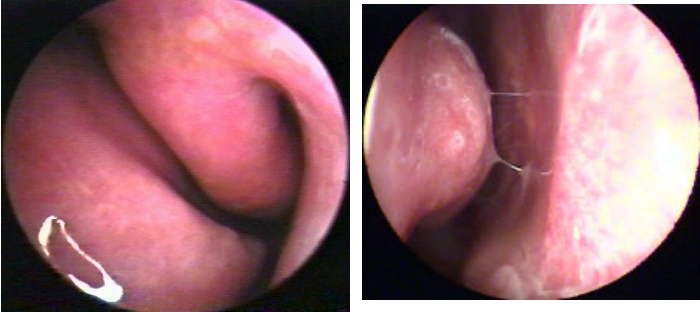 <p>pale, boggy inflamed lower turbinates; rhinorrhea, eye irritation, seasonal</p>