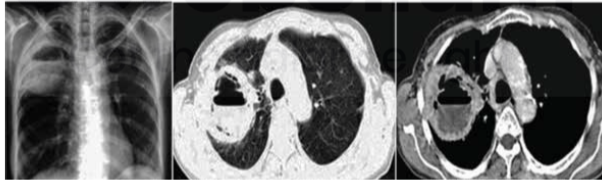 <p>Necrotic thick-walled cavity with air-fluid level</p>