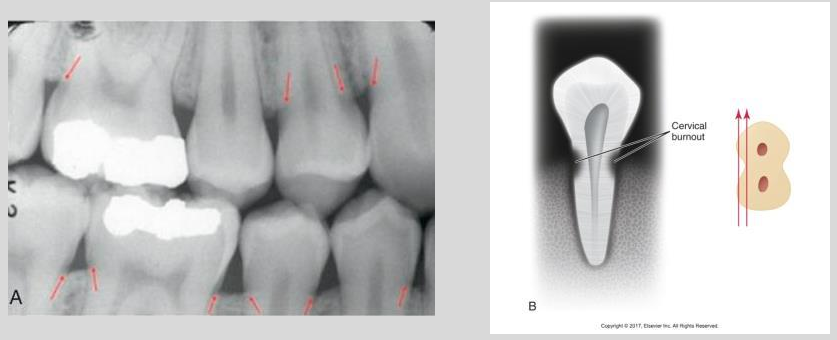 <p>Cervical burnout on posterior teeth</p>