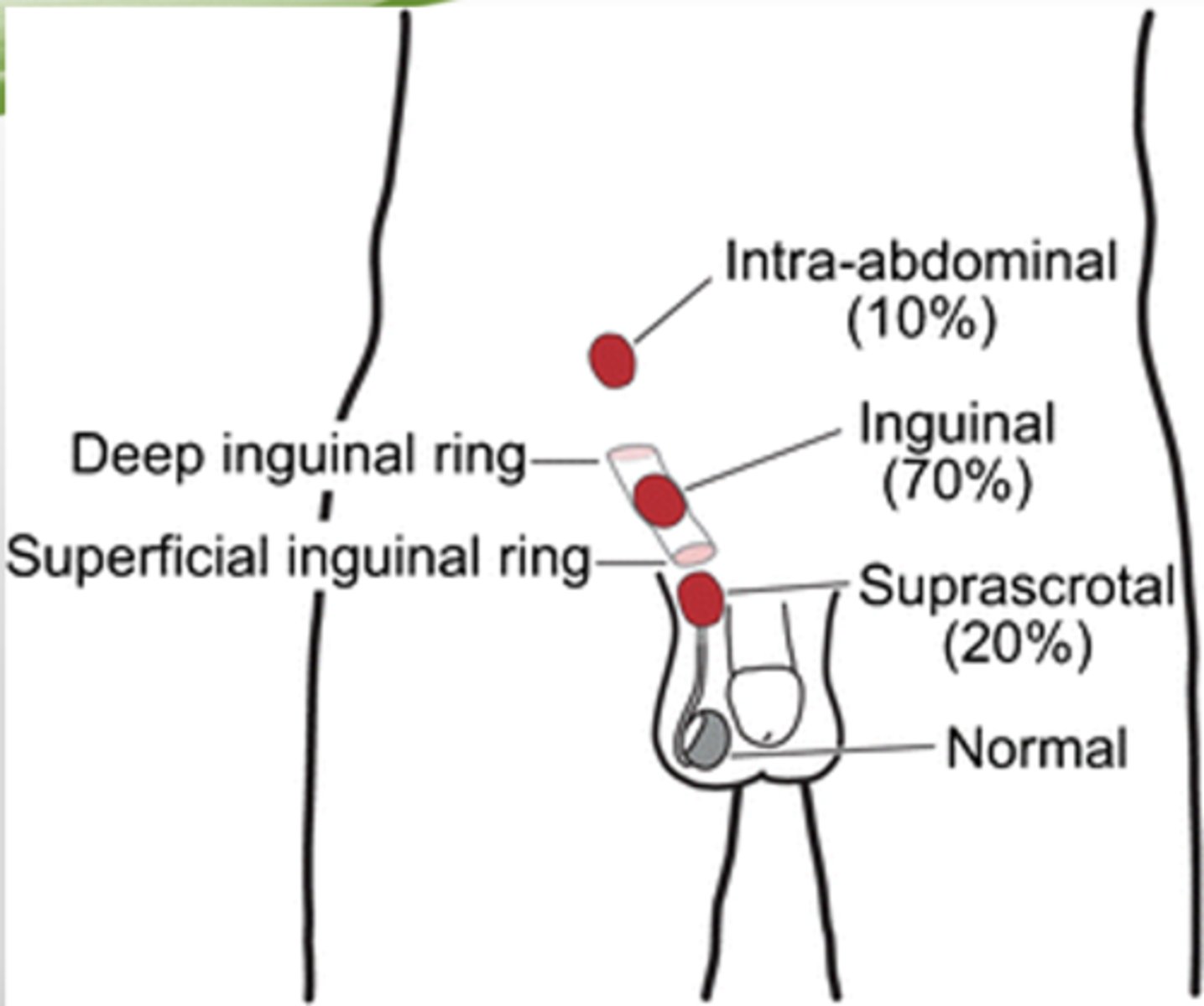 <p>inguinal canal</p>