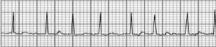 <p>Atrial fibrillation </p><p>No effective beating </p>
