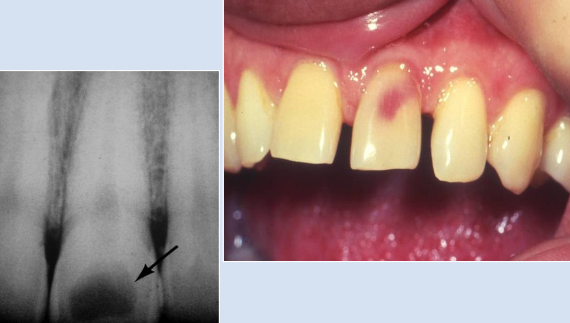 <p>Rare, injury to pulpal tissue (TRAUMA), when crown is affected known as <strong>pink tooth of mummery</strong></p>