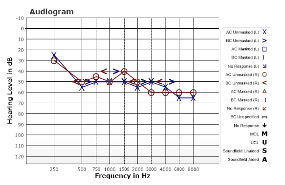 <p>How would you describe this audiogram?</p>